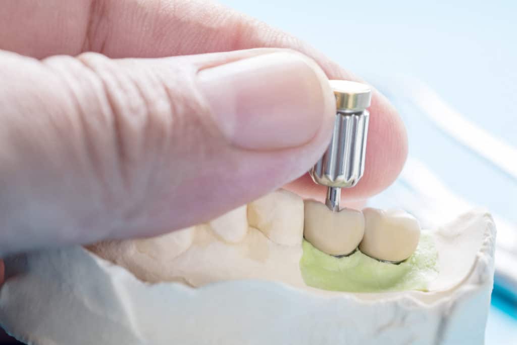dental-implants-in-toronto